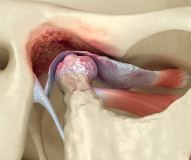 Temporomandibular joints arthritis and dislocated articular disc. Medically accurate 3D illustration. clipart