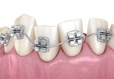 Anormal diş pozisyonu ve metal diş telleriyle düzeltme. Tıbbi olarak doğru olan 3 boyutlu diş illüstrasyonu