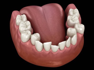 Overcrowded teeth, abnormal dental occlusion. Medically accurate tooth 3D illustration clipart