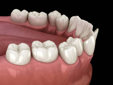 Aşırı kalabalık dişler, anormal diş tıkanıklığı. Tıbbi olarak doğru diş 3D illüstrasyon