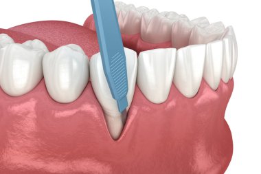 Sakız resesyonu, yumuşak doku nakli ameliyatı. Diş tedavisinin 3 boyutlu illüstrasyonu