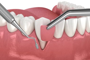 Gum Recession: Soft tissue graft surgery. 3D illustration of Dental  treatment clipart