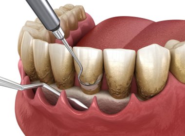 Açık curettage: Ölçekleme ve kök planlama (geleneksel periodontal terapi). İnsan diş tedavisinin tıbbi açıdan doğru üç boyutlu çizimi