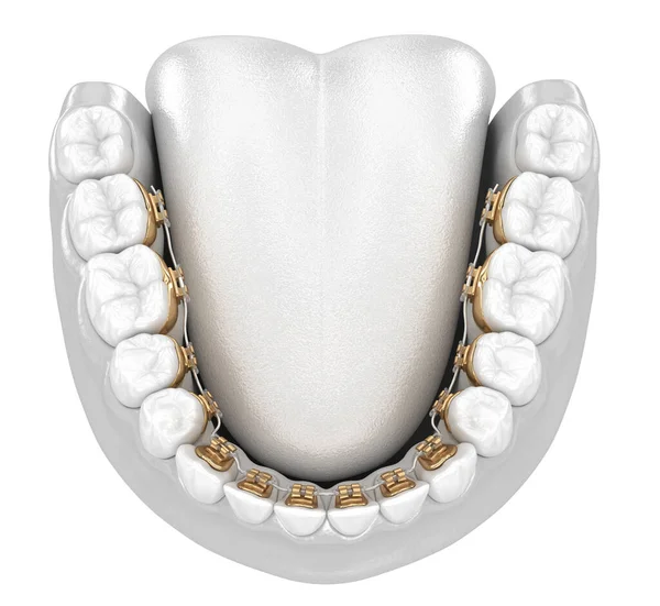 Dentes Saudáveis Com Aparelho Ouro Conceito Estilo Branco Ilustração Dental — Fotografia de Stock