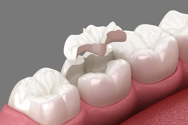 镶嵌陶瓷冠层 医学上准确的人类牙齿治疗三维图像 — 图库照片