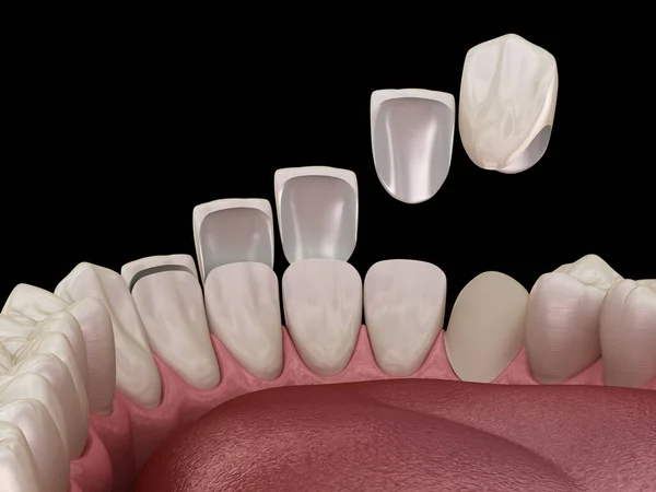 Dental veneer placement procedure. Dental 3D illustration