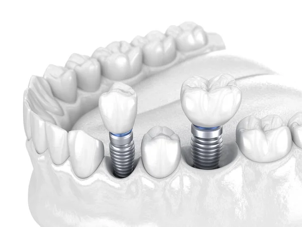 Premolar Και Molar Δόντι Κορώνα Εγκατάσταση Πάνω Από Εμφύτευμα Λευκό — Φωτογραφία Αρχείου