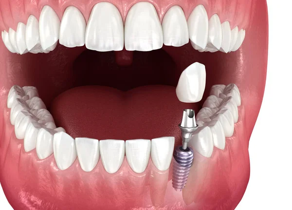 Impianto Dentale Corona Ceramica Illustrazione Del Dente Clinicamente Accurata — Foto Stock