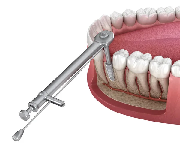 义齿扭矩扳手使植入物固定在骨上 医学上准确的牙科3D图像 — 图库照片