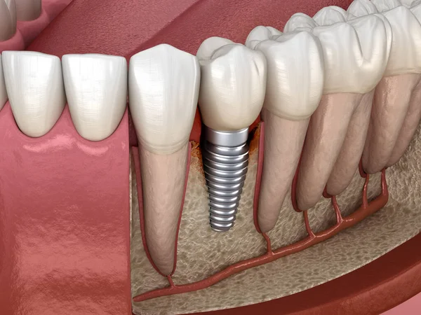 目に見える骨損傷を有する歯周炎 医学的に正確な3Dイラスト — ストック写真