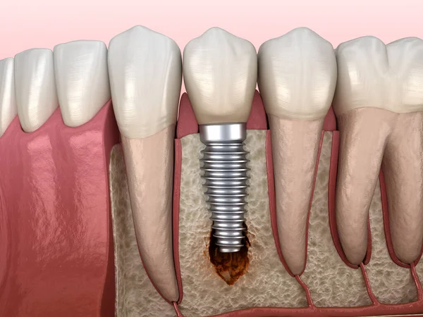 目に見える骨損傷を有する歯周炎 医学的に正確な3Dイラスト — ストック写真