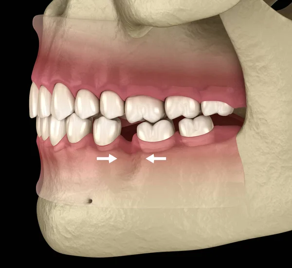 臼歯を失った後に変形する Popov Godon現象の3Dイラスト — ストック写真