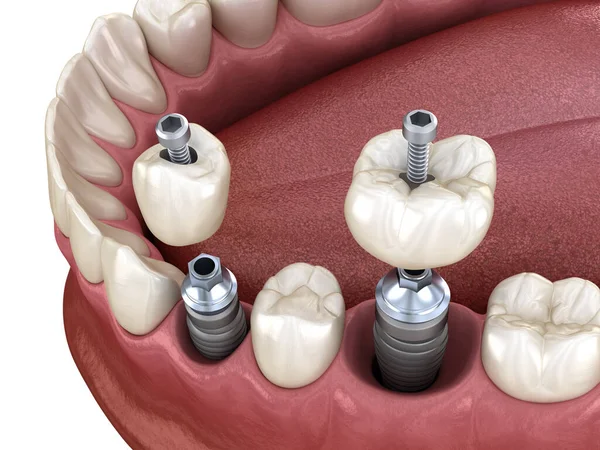 Instalación Corona Dentaria Premolar Molar Sobre Implante Fijación Tornillo Ilustración — Foto de Stock