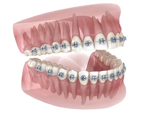 Bretelle Metalliche Modello Dentale Trasparente Illustrazione Clinicamente Accurata — Foto Stock