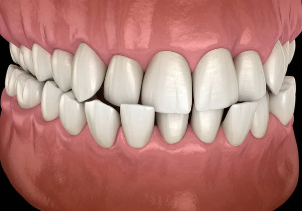 前牙交叉咬合 牙齿错牙合 医学上准确的牙齿3D图像 — 图库照片