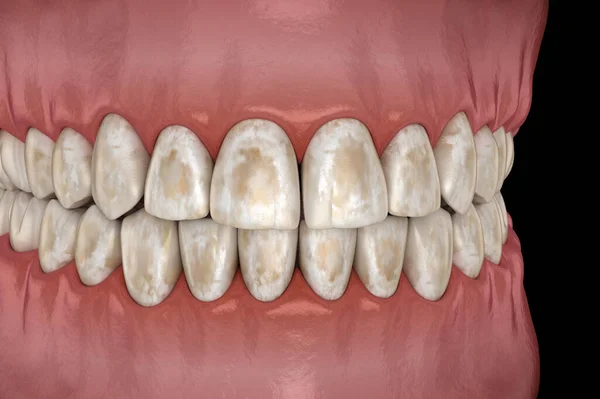 Desmineralização Dentária Remoção Minerais Dos Tecidos Duros Esmalte Dentina Cementu — Fotografia de Stock