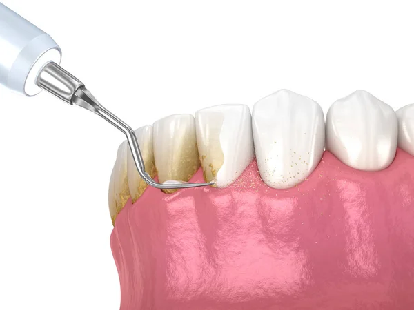 口腔卫生 烫伤和根部修整 常规牙周病治疗 医学上准确的人类牙齿治疗三维图像 — 图库照片