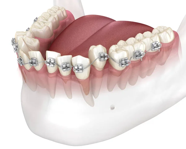 비정상적 치아의 위치와 교정에 교정기를 의학적으로 — 스톡 사진