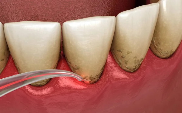 Zahnlaser Entfernen Zahnstein Und Dünne Schichten Der Infizierten Haut Zahnärztliche — Stockfoto