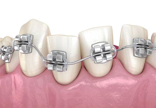 異常な歯の位置と金属ブレースの治療で補正 医学的に正確な歯科3Dイラスト — ストック写真