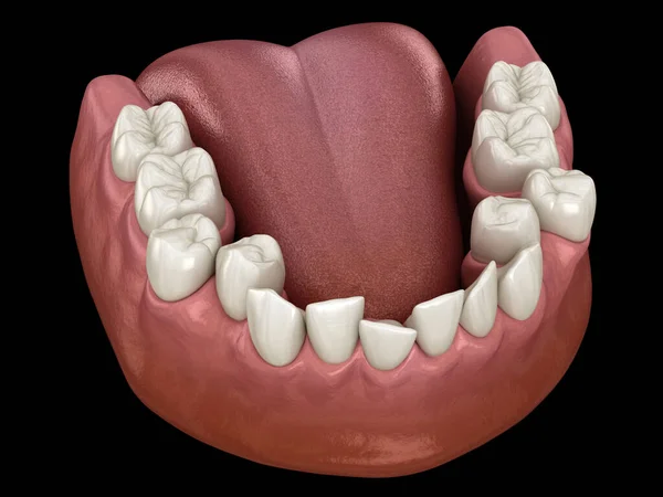 Overcrowded teeth, abnormal dental occlusion. Medically accurate tooth 3D illustration