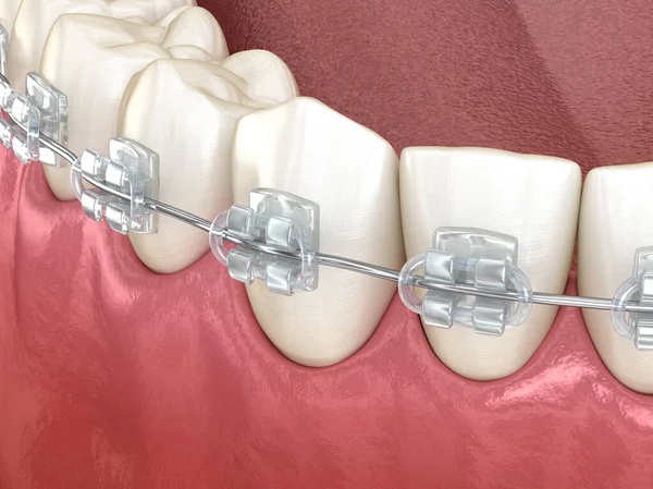 Mandibulaire Kaak Heldere Beugels Medisch Nauwkeurige Tandheelkundige Illustratie — Stockfoto