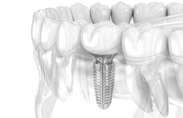 Οδοντιατρική Εμφύτευση Και Κεραμική Κορώνα Απεικόνιση Των Ανθρώπινων Δοντιών — Φωτογραφία Αρχείου
