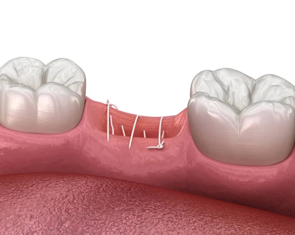 Stitches Gum Tooth Extraction Illustration Dental Treatment 로열티 프리 스톡 사진
