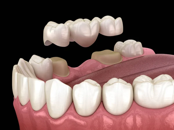 磨牙和磨牙前牙及牙桥的位置 医学上准确的3D图像 图库照片