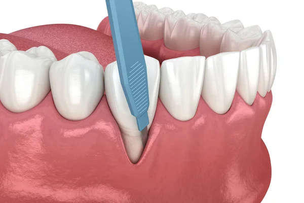 Zahnfleischrezession Weichteiltransplantation Illustration Der Zahnärztlichen Behandlung Stockbild