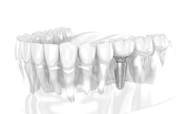 Tandheelkundig Implantaat Keramische Kroon Illustratie Van Menselijke Tanden Rechtenvrije Stockafbeeldingen