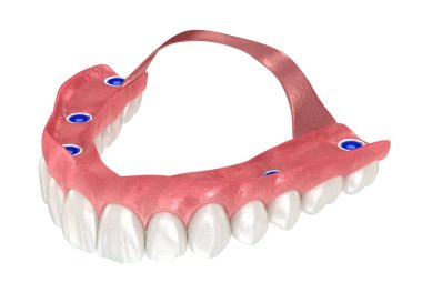 Altı implanta dayalı çıkarılabilir protez. Diş 3B illüstrasyon