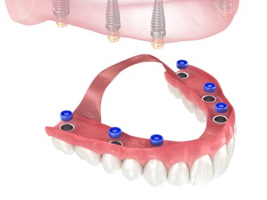 Altı implanta dayalı çıkarılabilir protez. Diş 3B illüstrasyon