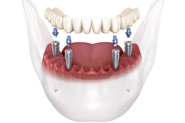 Dental rosthesis based on 4 implants. Dental 3D illustration clipart