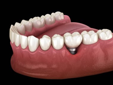 Çiklet durgunluğu olan Peri-implantitis. Diş implantı kavramının tıbben doğru üç boyutlu çizimi