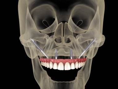 Elmacık kemiği implantları tarafından desteklenen Maxillary protezi. İnsan dişlerinin ve protezlerinin tıbbi açıdan doğru üç boyutlu çizimi