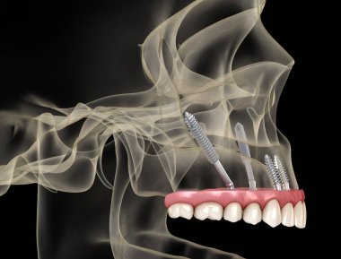 Elmacık kemiği implantları tarafından desteklenen Maxillary protezi. İnsan dişlerinin ve protezlerinin tıbbi açıdan doğru üç boyutlu çizimi