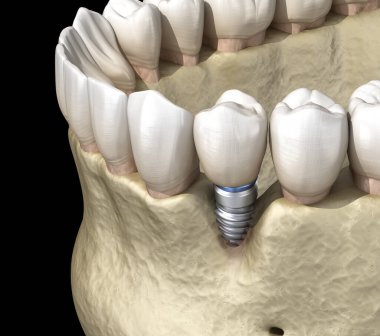Görünür kemik durgunluğu olan Peri-implantitis. Diş implantı kavramının tıbben doğru üç boyutlu çizimi
