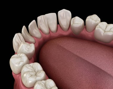 Aşırı kalabalık dişler, anormal diş tıkanıklığı. Tıbbi olarak doğru diş 3D illüstrasyon