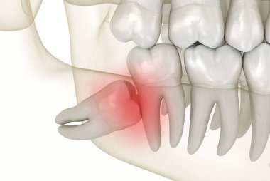 Yirmilik dişlerin kafa karıştırıcı etkisi. Tıbbi olarak doğru diş 3D illüstrasyon