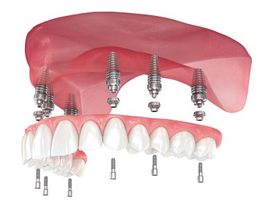 Maxillary prosthesis with gum All on 6 system supported by implants. Dental 3D illustration clipart