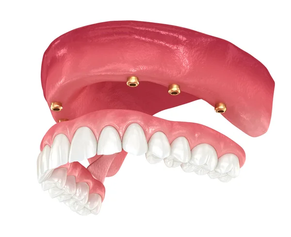Protesi Maxillare Con Gengiva Tutto Sistemi Supportati Impianti Illustrazione Dentale — Foto Stock