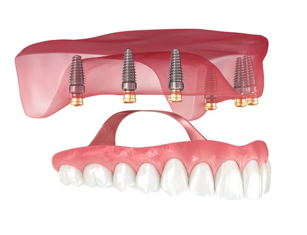 Prótese Removível Baseada Seis Implantes Ilustração Dental — Fotografia de Stock
