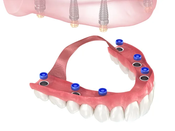 基于6个植入物的可切除假肢 牙科3D图解 — 图库照片