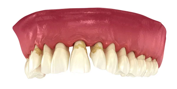 歯周炎と歯茎の不況 医学的に正確な3Dイラスト — ストック写真