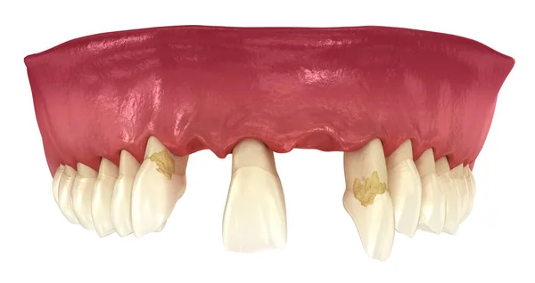 Parodontite Récession Des Gencives Perte Dents Illustration Médicalement Précise — Photo