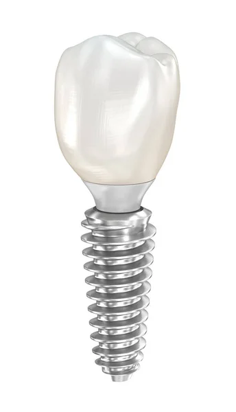 Стоматологический Имплантат Керамическая Корона Медицинская Точность Трехмерной Иллюстрации Зубов — стоковое фото
