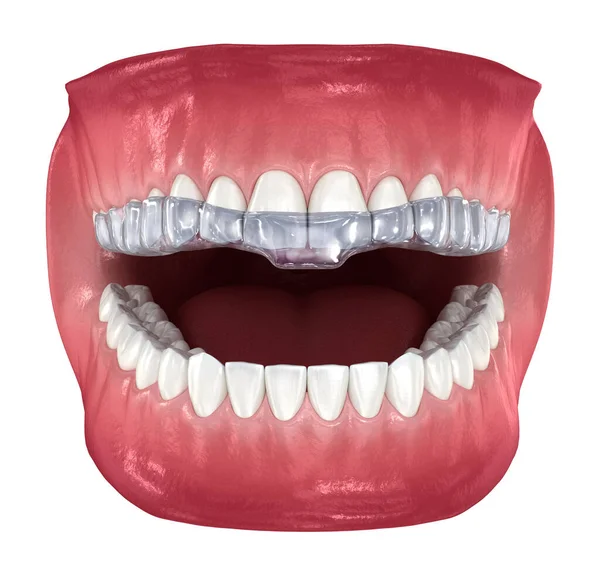 Bite Splint Bita Korrigering Medicinskt Korrekt Dentala Illustration — Stockfoto