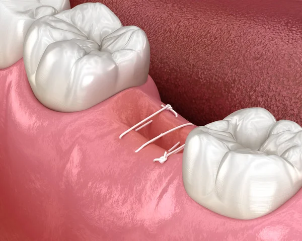 Stitches in gum after tooth extraction. 3D illustration of dental treatment