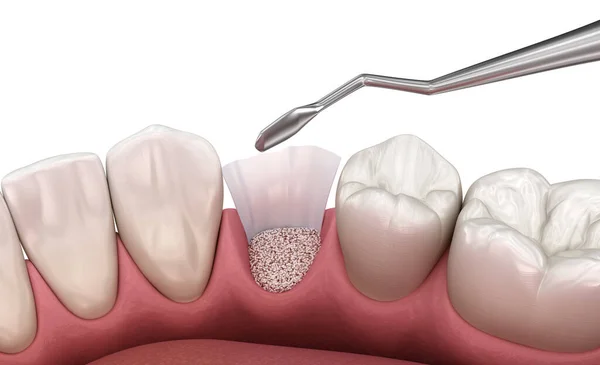 Cirurgia Aumento Adicionando Osso Artificial Após Extração Dentária Ilustração — Fotografia de Stock